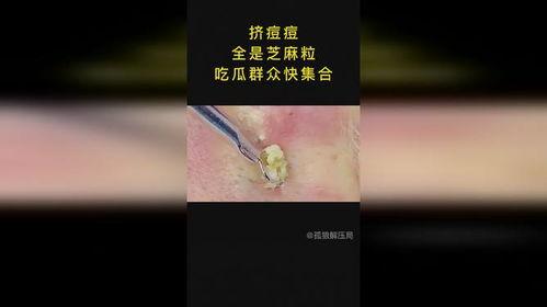 痤疮可以吃瓜么,瓜类食物的适宜与禁忌