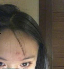 痤疮可以吃瓜么,瓜类食物的适宜与禁忌